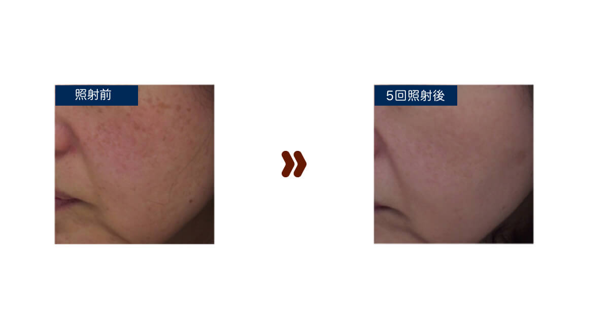 ステラM22の症例紹介そばかす・毛穴の開き