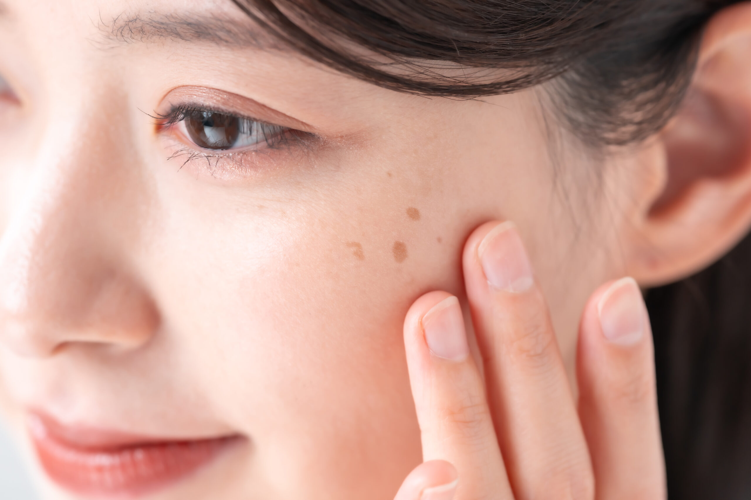 「シミ」の種類を医師が徹底解説！老人性色素斑、肝斑とは？見分け方は？
